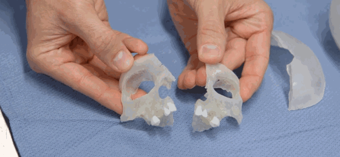 violet's-skull-3D-printing-boston-children's-hospital