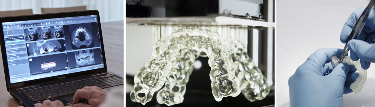 3D scan of teeth for Vertex-Dental NextDent 3D printed crown