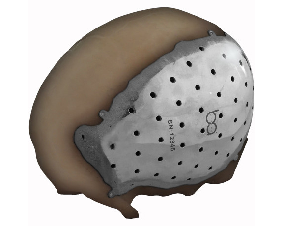 bio architects 3D printed titanium cranio and craniofacial implant