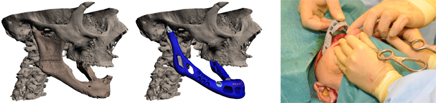 world_first_metal_AM_mandible_implant14