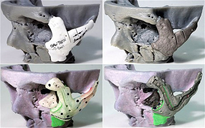 3d printing facial reconstruction