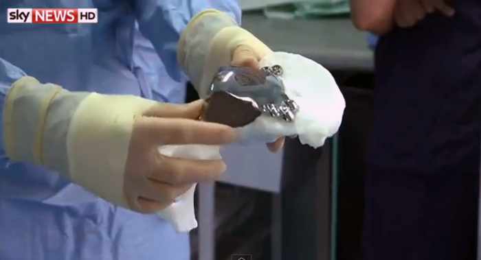 3D printed hip replacement