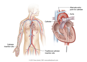 Cardiac Catheterization for 3D printed catheter path