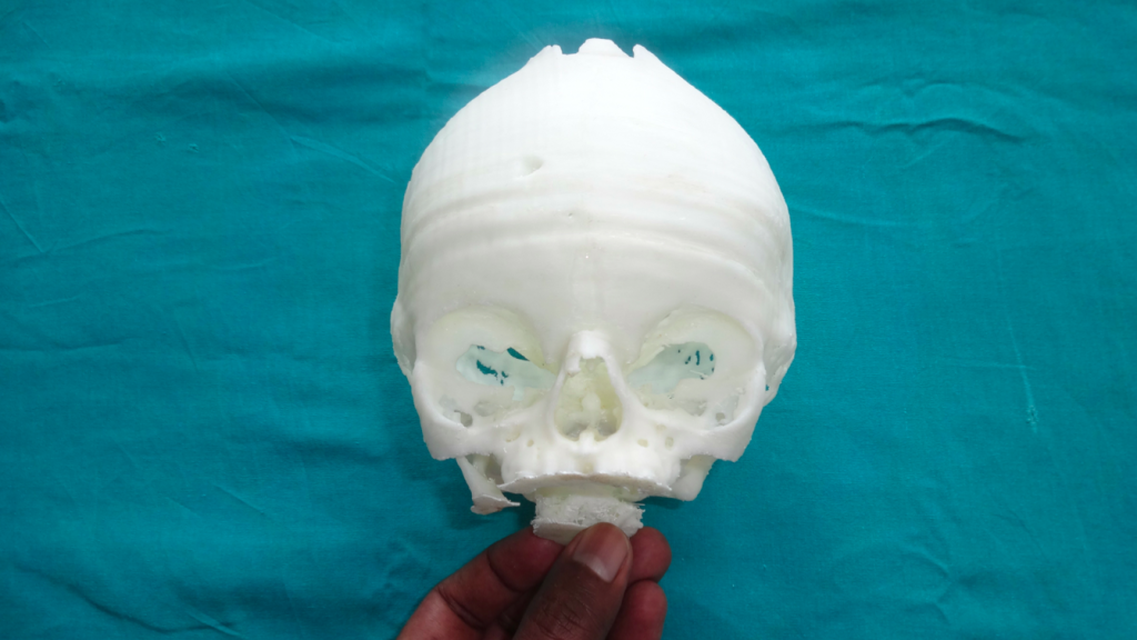 3D printed skull for surgery performed in India