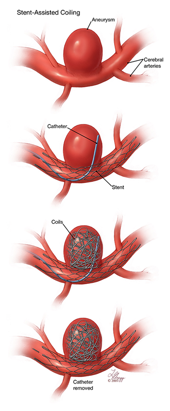 aneurysm and coil ASU 3D printing research