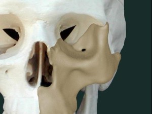 OPM maxilla reconstruction