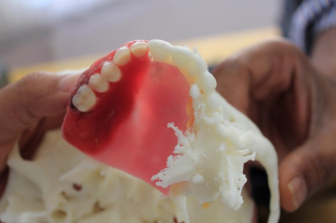 jaw implant osteo3d 3d printing