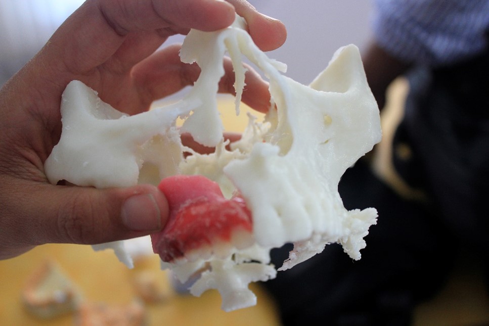 jaw implant osteo3d 3d printing