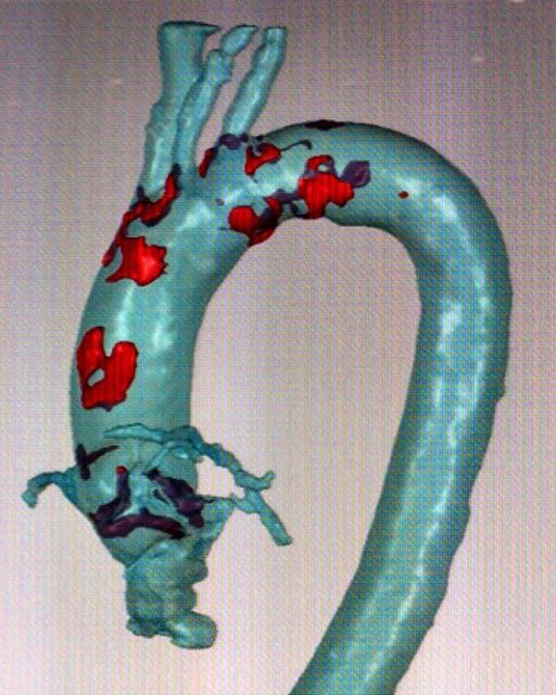 3d printing aorta valve