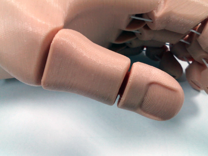 3D printed flexi hand prosthetic