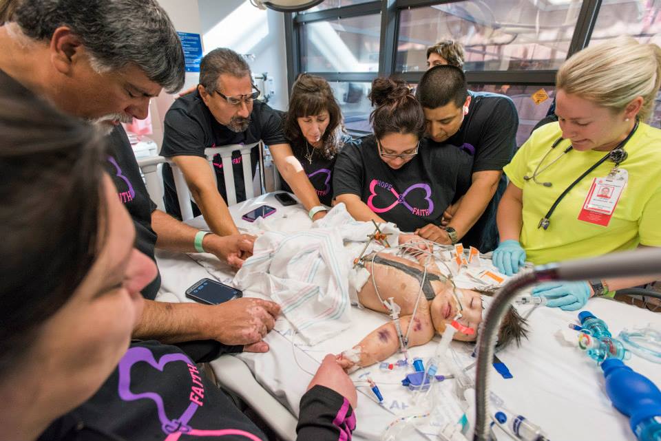 Adeline Mata conjoined twin separated with 3D printed model