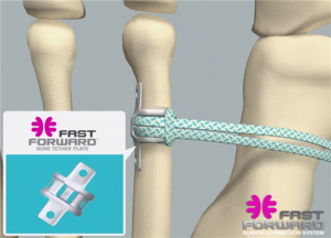 FastForward Bunion Correction System medshape receives FDA clearance for 3D printed