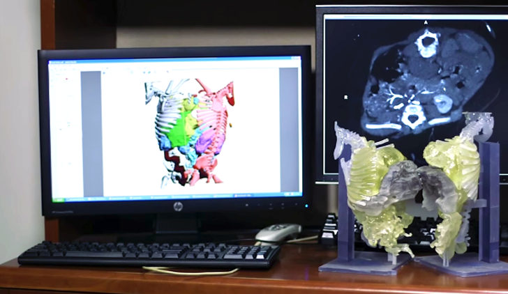 3D printed models for conjoined twins from materialise