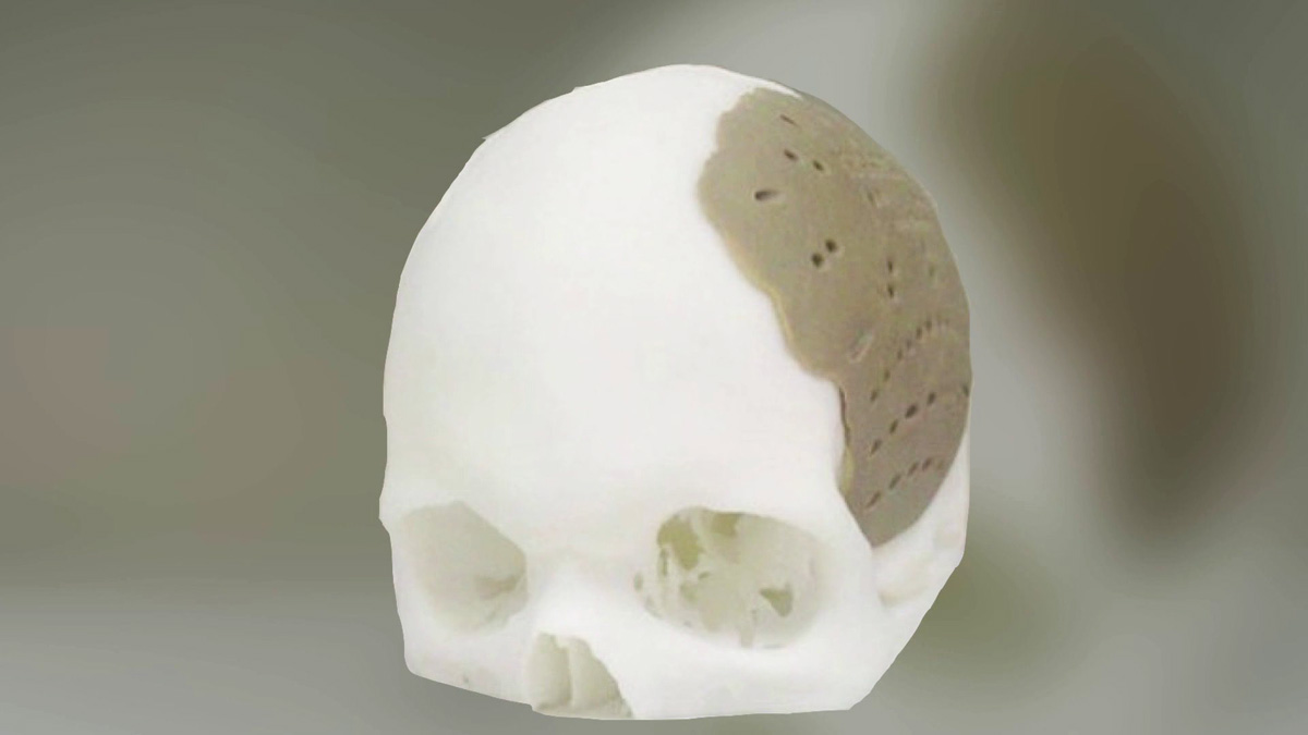 oxford performance materials 3D printed skull implant