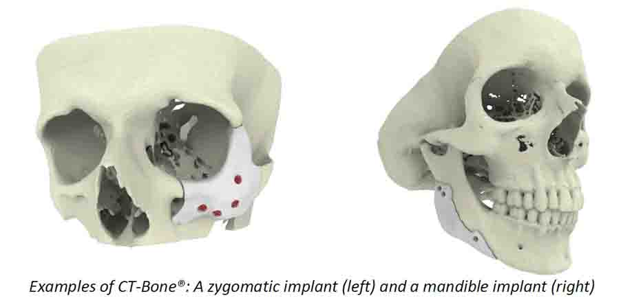 3D Printed Bone Implants are Here - 3D Printing Industry