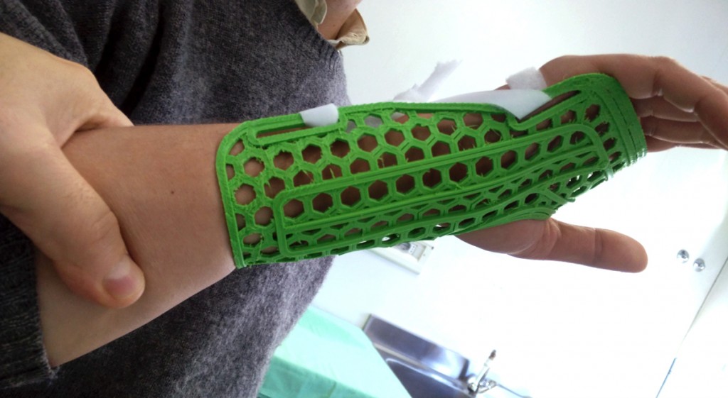 3D printed splint from WASP