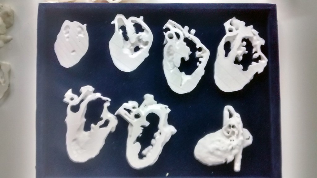 11-month-old Lavesh 3D printed heart surgery in India in parts