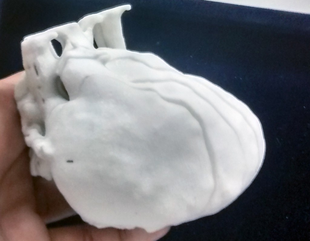11-month-old Lavesh 3D printed heart surgery in India sahas softech
