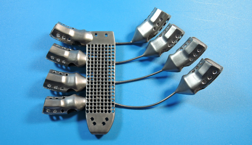 3D printed Sternum and rib implant back for 54 year old cancer patient in spain from CSIRO and Anatomics