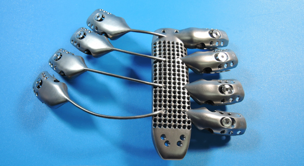 3D printed Sternum and rib implant front for 54 year old cancer patient in spain from CSIRO and Anatomics