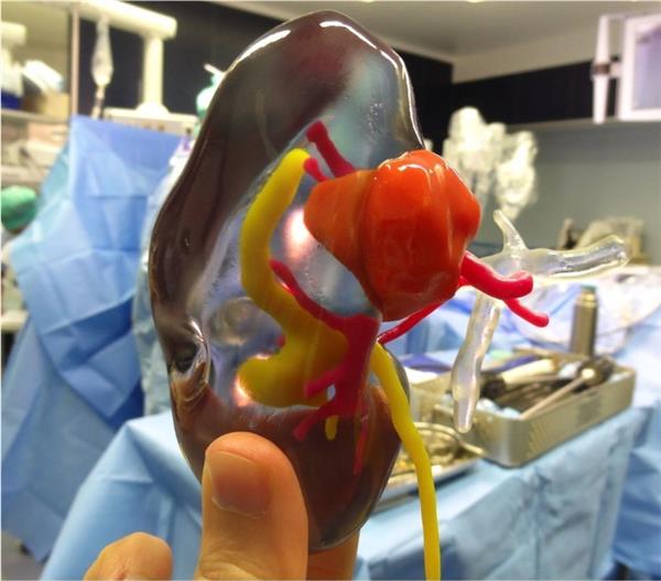 3dprinting_french-hospital-advancements-complex-kidney-surgery-color-coded-3dprinted-models-2