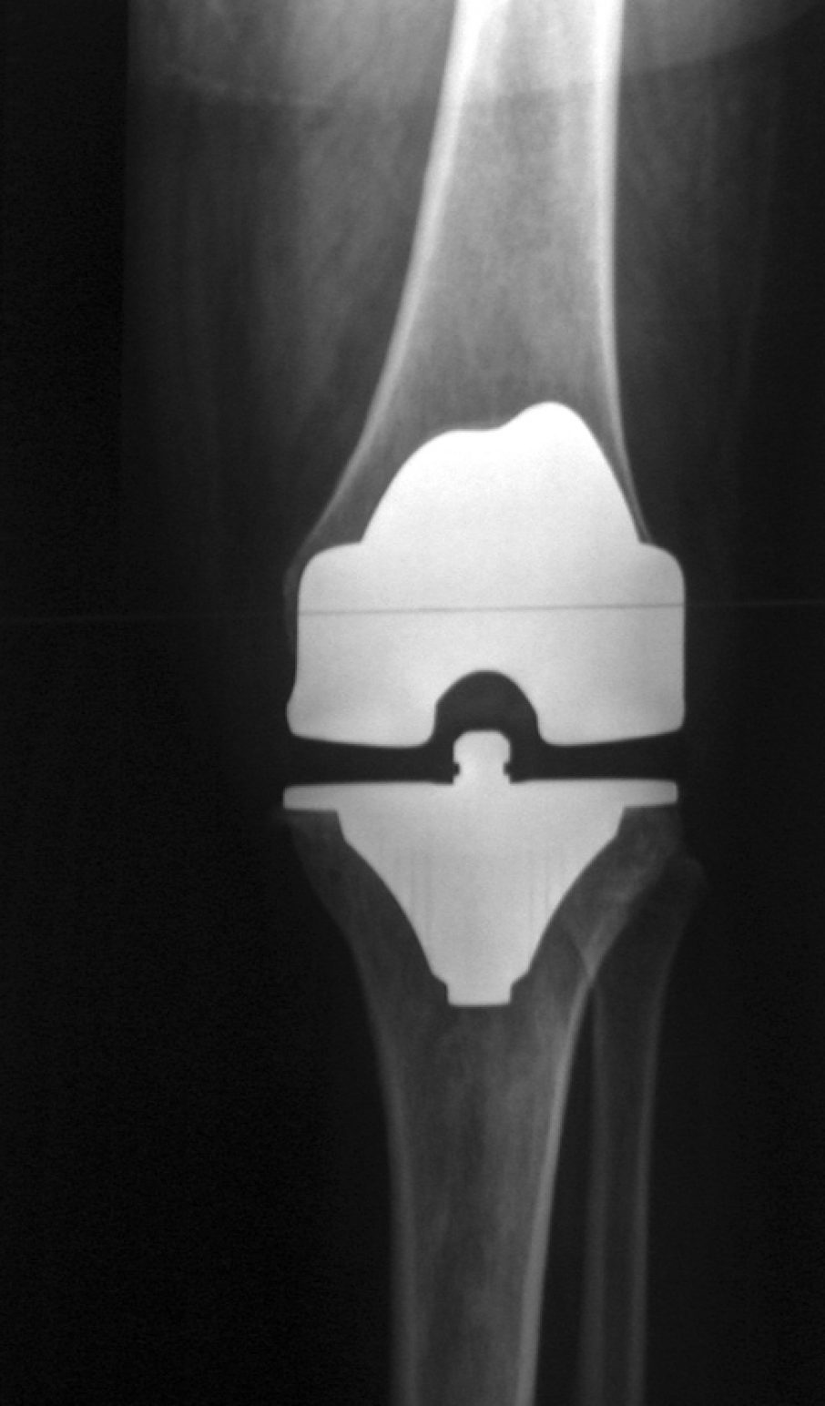 FDA produces 3D printing medical guidelines - 3DprinteDkneereplacement 1 906x1544