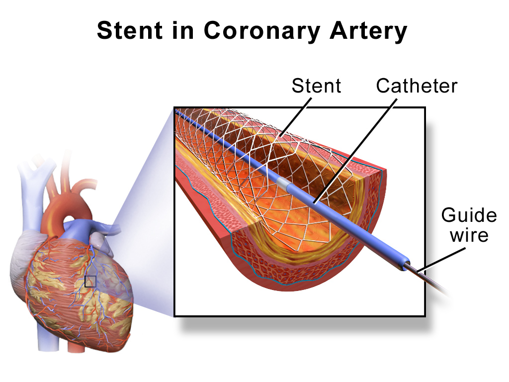 3D printed stents could improve vascular surgery