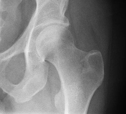 Bone implants could be made with your own bone in the future