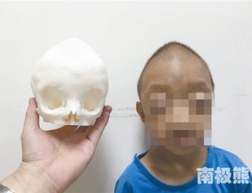 Craniosynostosis patient gets help from 3D printing technology