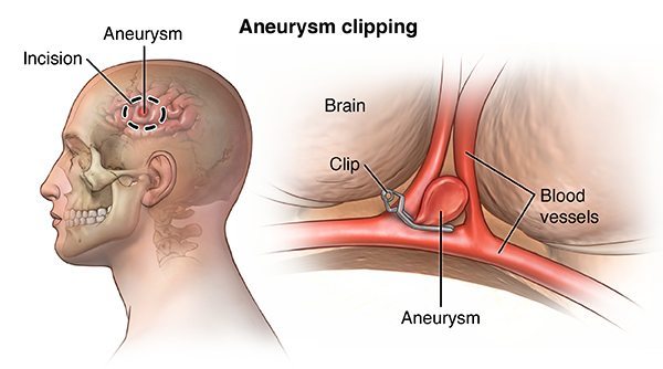 Clipping aneurysms