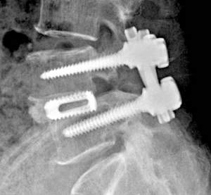 An x-ray showing the placing of a posterial lumbar cage Image via: Korean Society of Spine Surgery 2012
