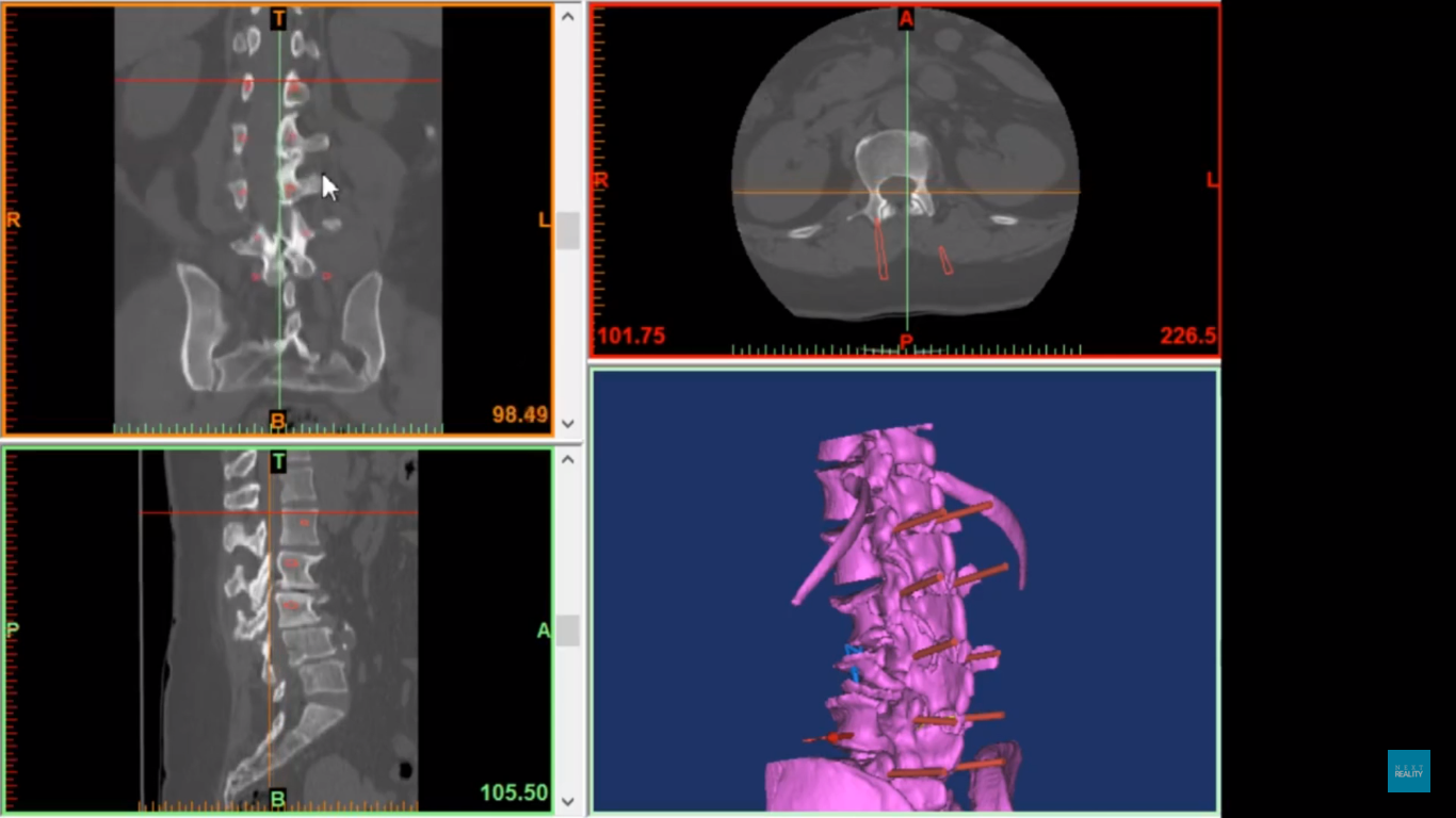 The 3D scans of the patient's spine. Image via NextReality. 
