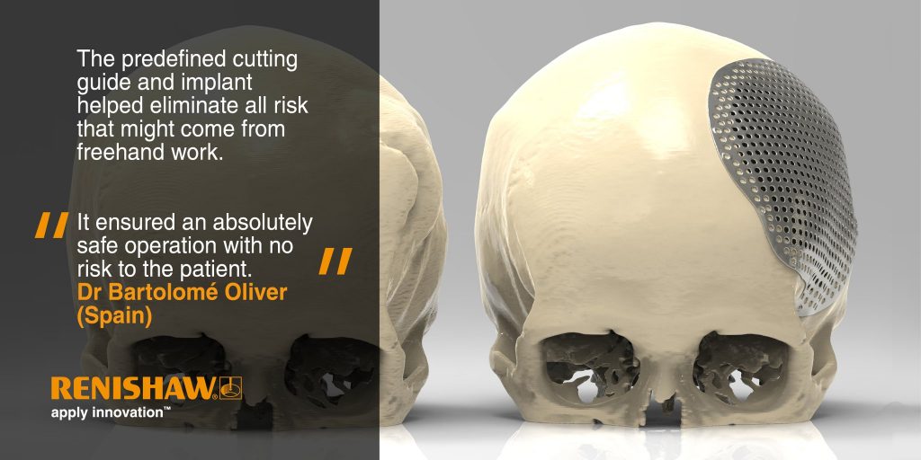 Preview of Renishaw's 3D printed skull plates. Image via: RenishawDental on Twitter