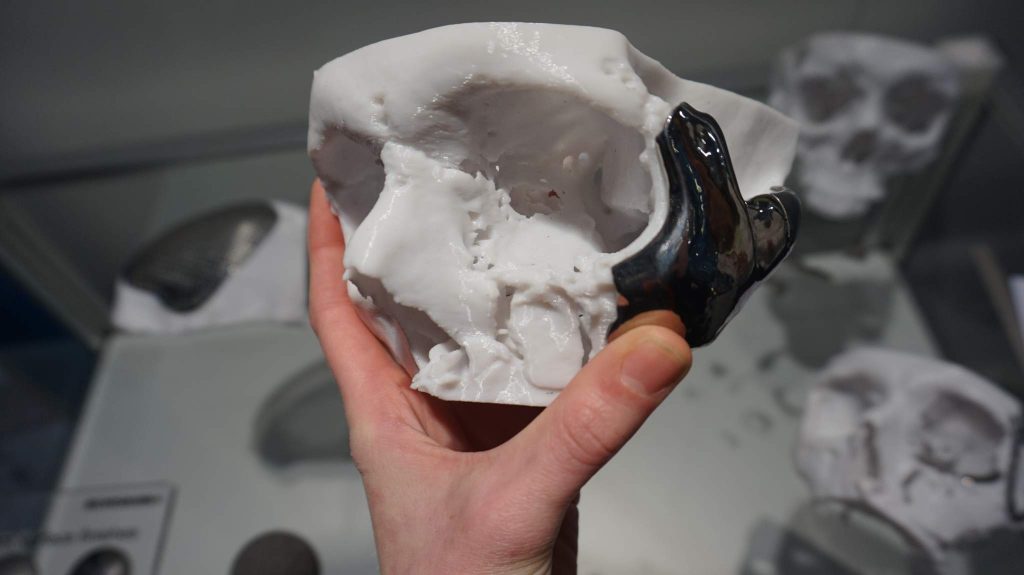 A 3D printed surgical guide used to help skull incisions by Renishaw.