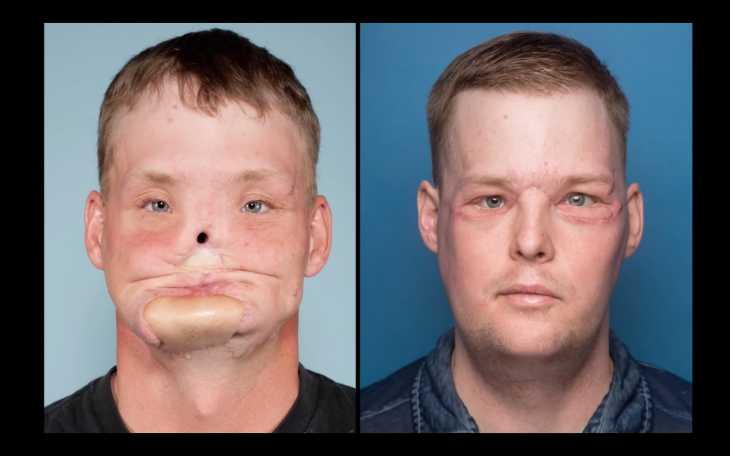 Andy Sandness before and after the facial transplantation. Photos via the Mayo Clinic