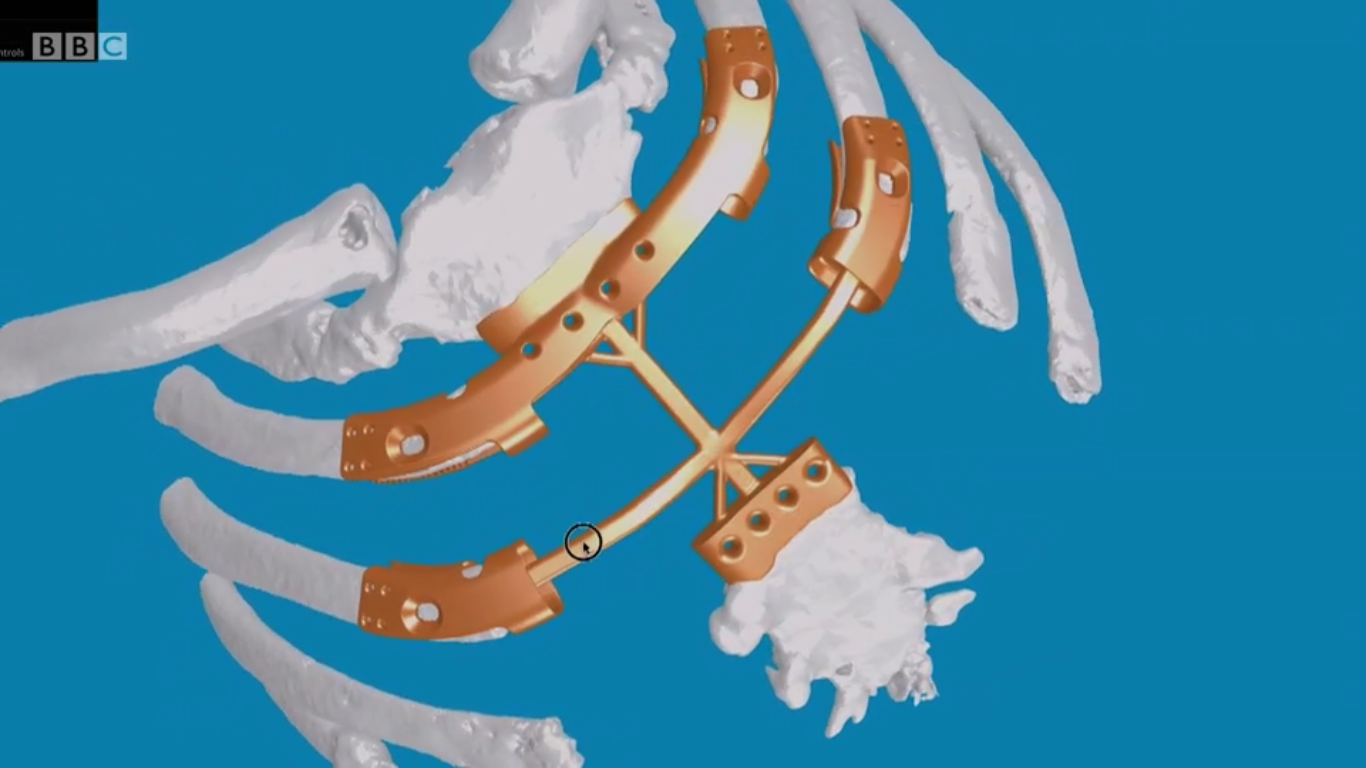 The 3D model of the sternum implant using AnatomicsC3D software. Image via BBC. 