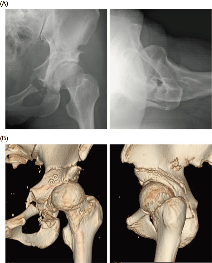 X-ray image and CT scan of the patient's hip. Figure via Kensuke Fukushima et al.