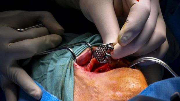 The implant during surgery. Photo by Eddie Jim.