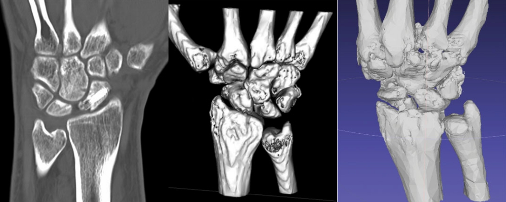 X-ray, CT scan and Meshmixer model. Images via Erin M. Taylor and Matthew L. Iorio