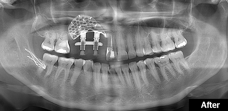 Titanium implant with dental screws. Image via The Sydney Morning Herald. 