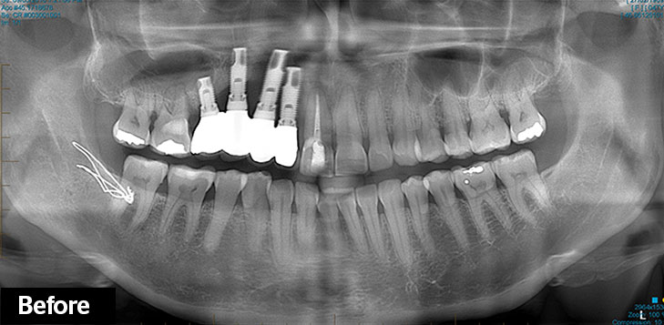 The implants in Susie's jaw before the surgery. Image via The Sydney Morning Herald. 