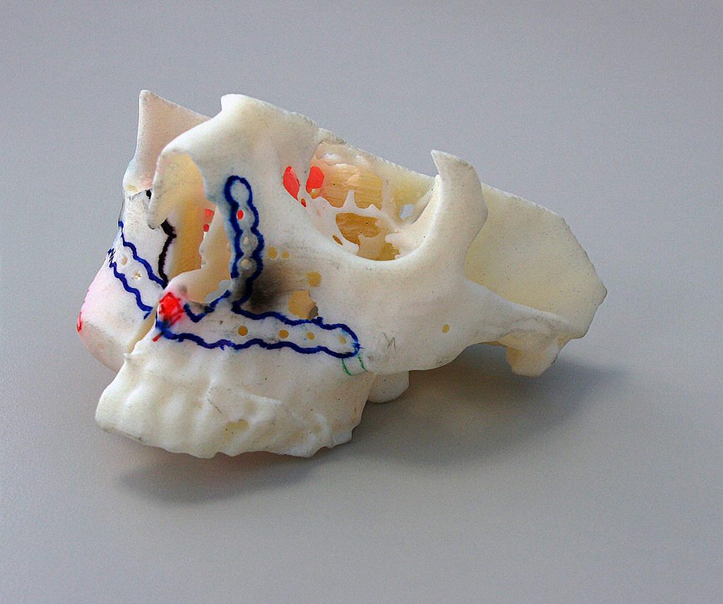 The Stratasys 3D Printer enables the creation of exact replicas of the patient's anatomy and allows customized fittings and pre-bending of plates. Photo via Stratasys.