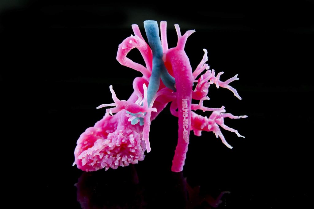 Materialise 3D printed, patient-specific anatomical models help medical professionals plan for surgeries and more effectively communicate with patients.