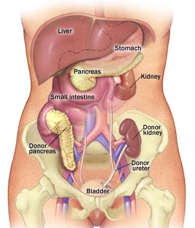 The implanted pancreas does not replace the existing organ. Image via the Mayo Clinic. 