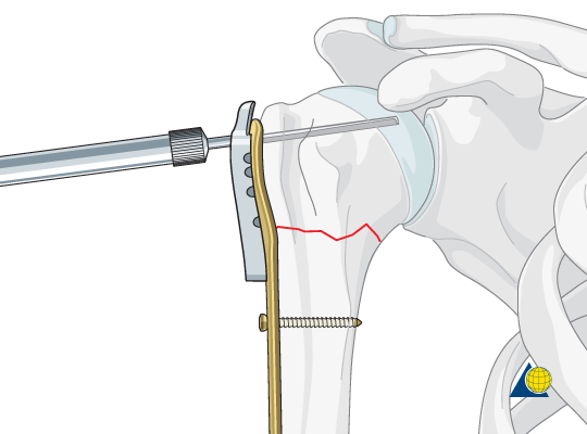 Diagram shows drilling into the shoulder joint bone. Image via AO Foundation. 