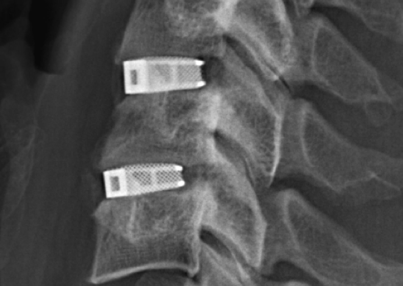 Cellular Titanium support cages successfully implanted in a patient’s spine. Image via EIT