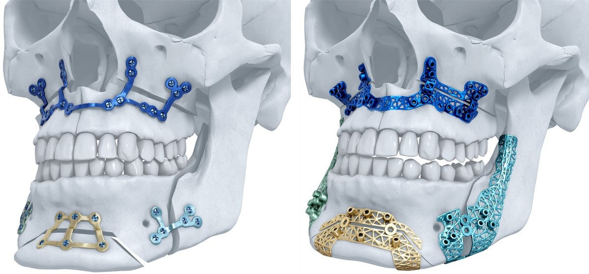 Materialise 3D printed titanium maxillofacial implants, distributed by DePuy Synthes. Image via Materialise NV on Twitter