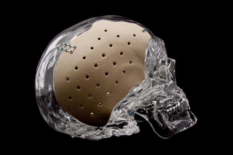 The OsteoFab® Patient Specific Cranial Device (OPSCD) from Oxford Performance Materials.