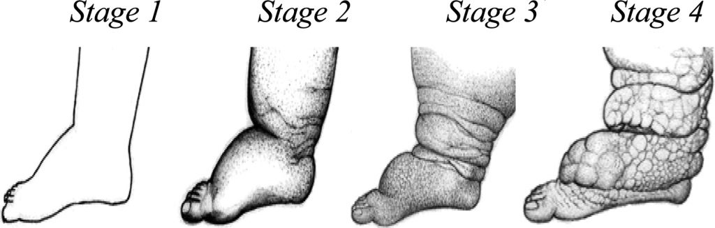 The various stages of lymphatic filariasis. Image via the Center for Compassion and Global Health