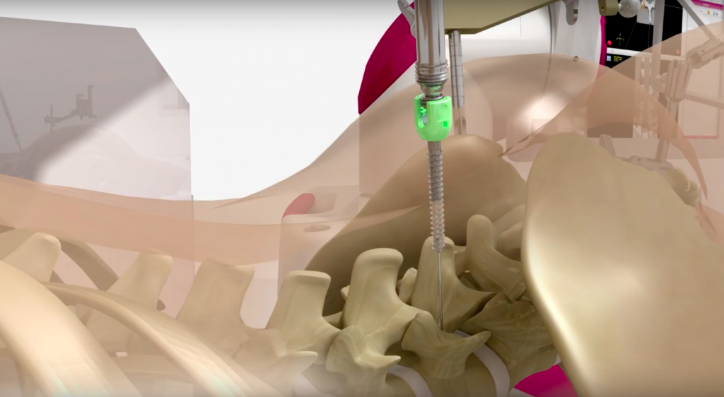 A 3D simulation of the injection stage of the operation, which surgeons required 3D models to prepare for. Image via Med Tech.